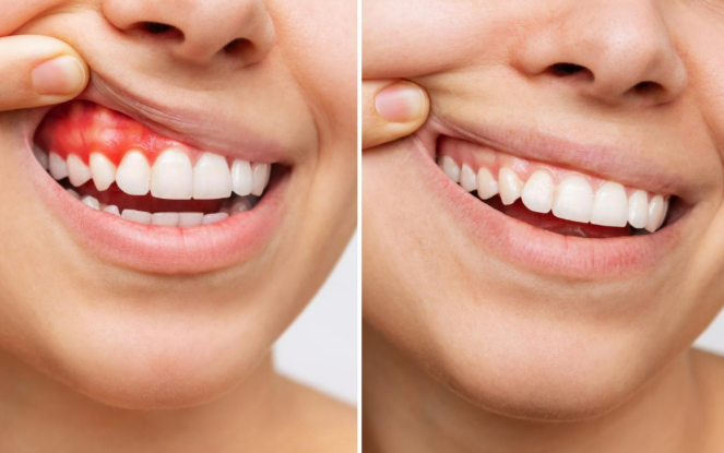 Comparativa de encías sanas y encías con gingivitis